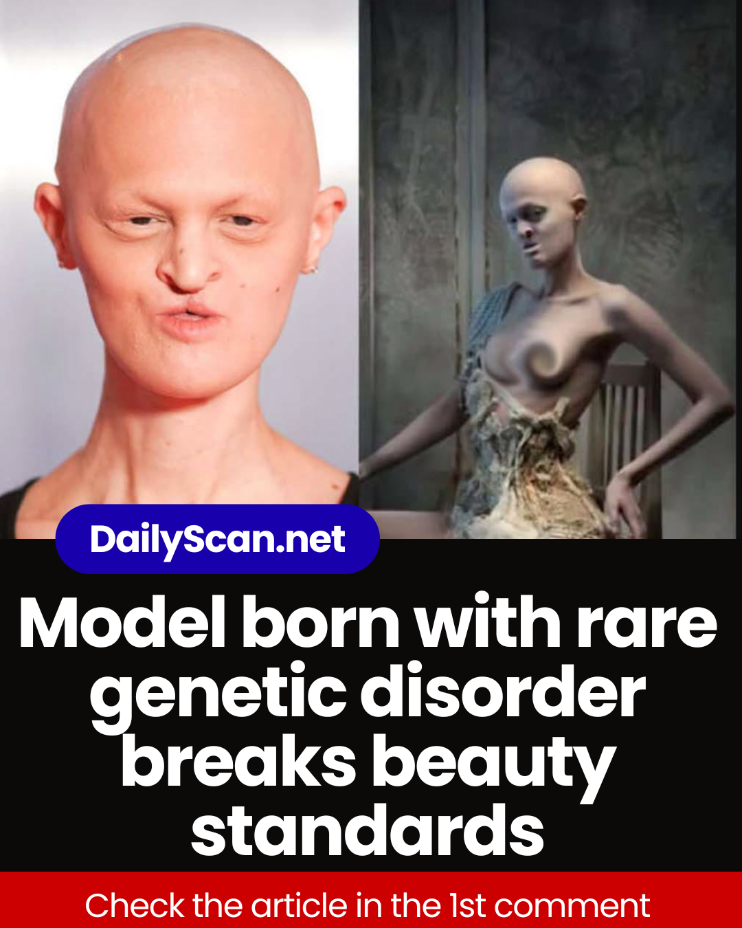 Model born with rare genetic disorder breaks beauty standards
