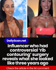 Influencer who had controversial ‘rib contouring’ surgery reveals what she looked like three years ago