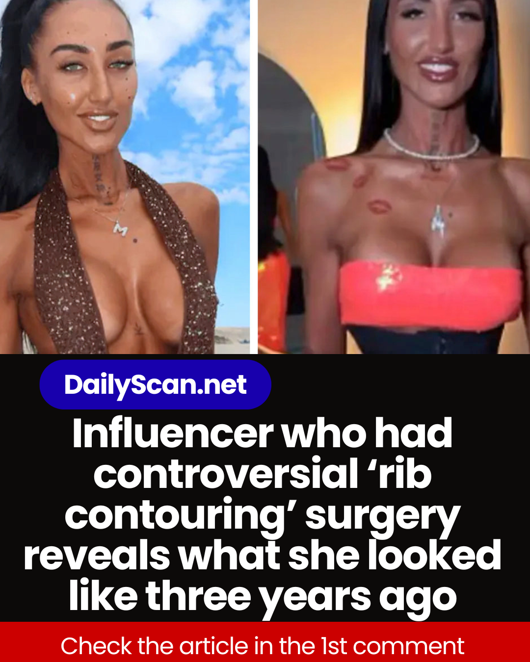 Influencer who had controversial ‘rib contouring’ surgery reveals what she looked like three years ago