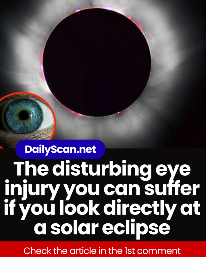 The disturbing eye injury you can suffer if you look directly at a solar eclipse