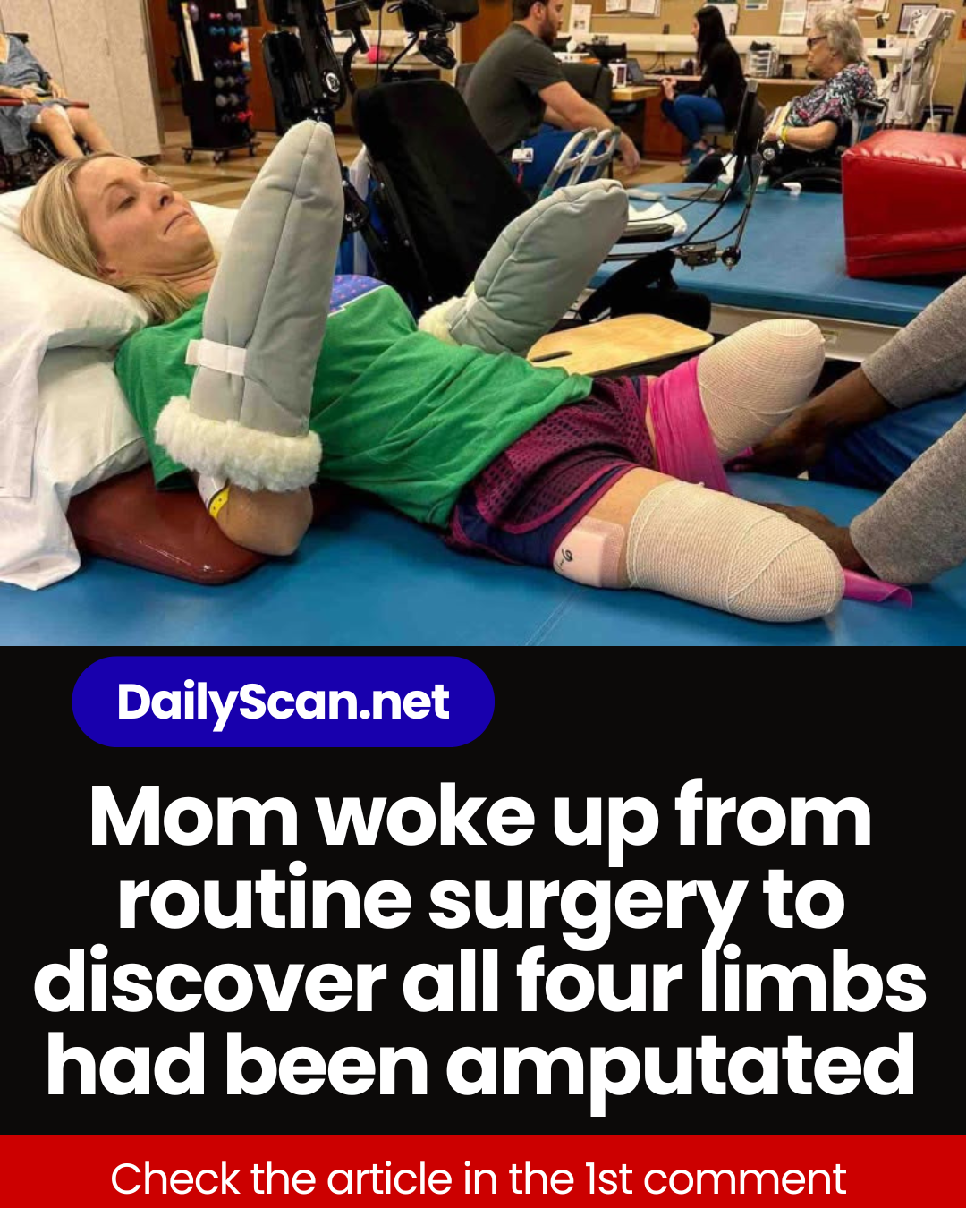 Mom woke up from routine surgery to discover all four limbs had been amputated