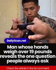 Man whose hands weigh over 19 pounds reveals the one question people always ask