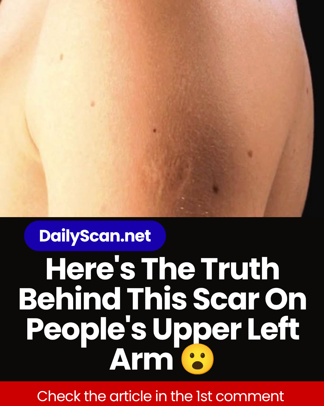 Smallpox vaccine scars: What they look like and why