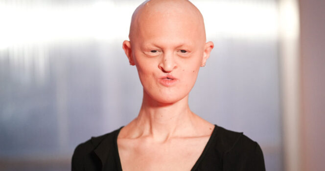 Model born with rare genetic disorder breaks beauty standards