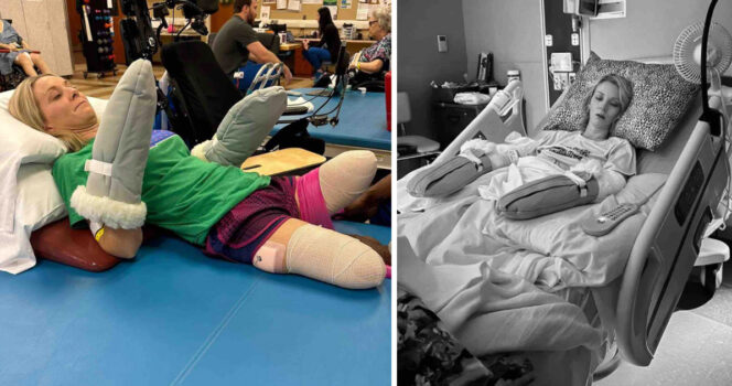 Mom woke up from routine surgery to discover all four limbs had been amputated