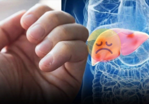 Don’t Ignore These 3 Hand Clues of Possible Liver Trouble