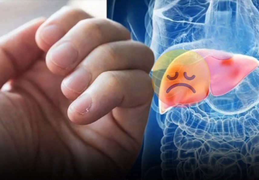 Don’t Ignore These 3 Hand Clues of Possible Liver Trouble