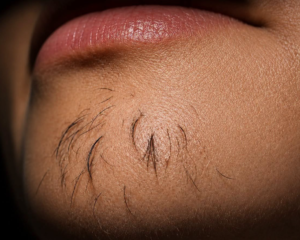 Why Chin Hair Grows in Women and What It May Indicate