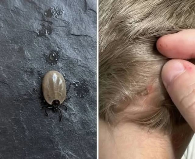 Does Anyone Know What Kind of Bug This Could Be? A Parent Finds an Unusual Insect on a Child’s Scalp