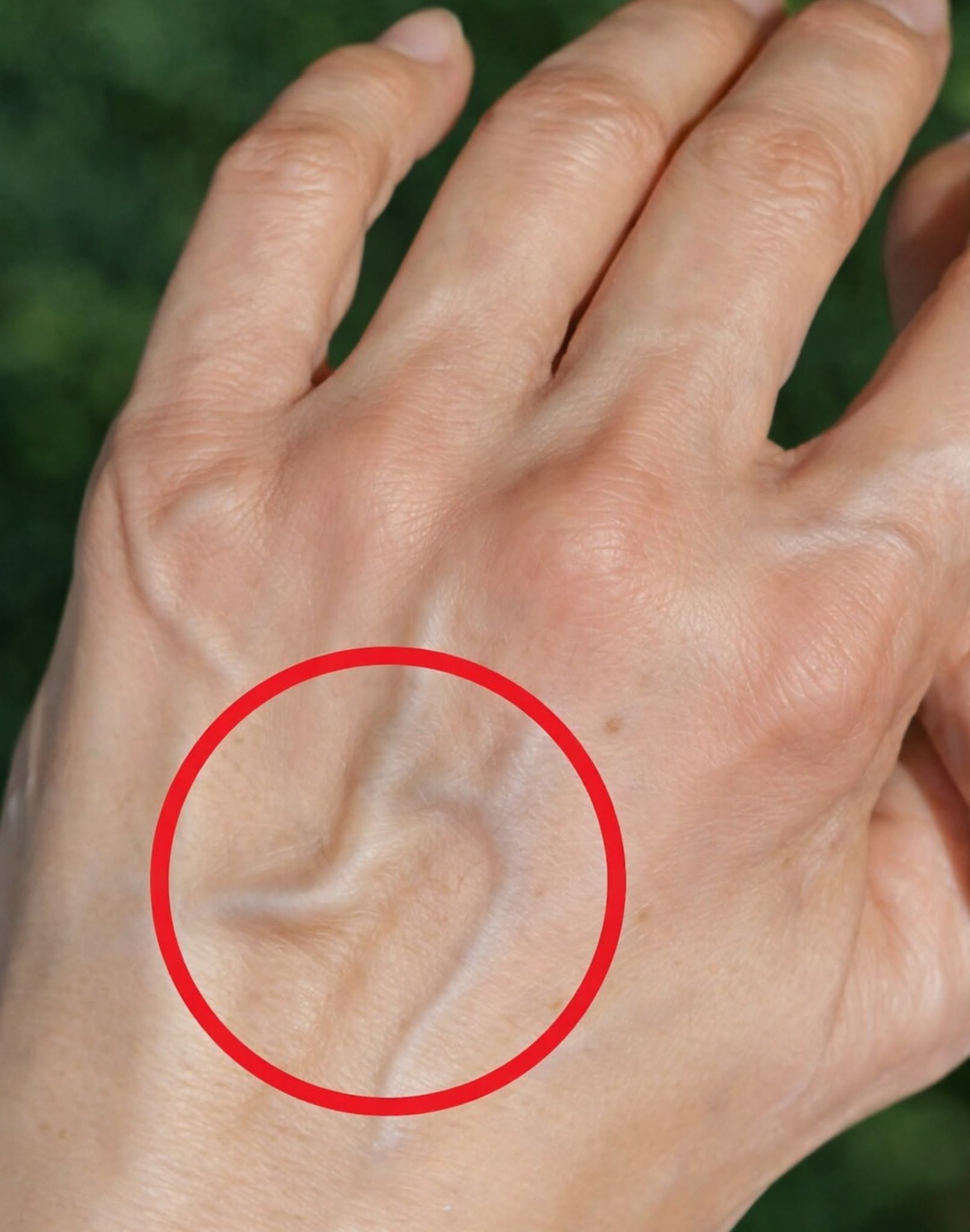 Why Are My Veins Suddenly So Visible? Causes, Warning Signs, and What to Do