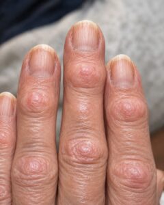 Hard Bumps on Finger Joints: What They May Mean