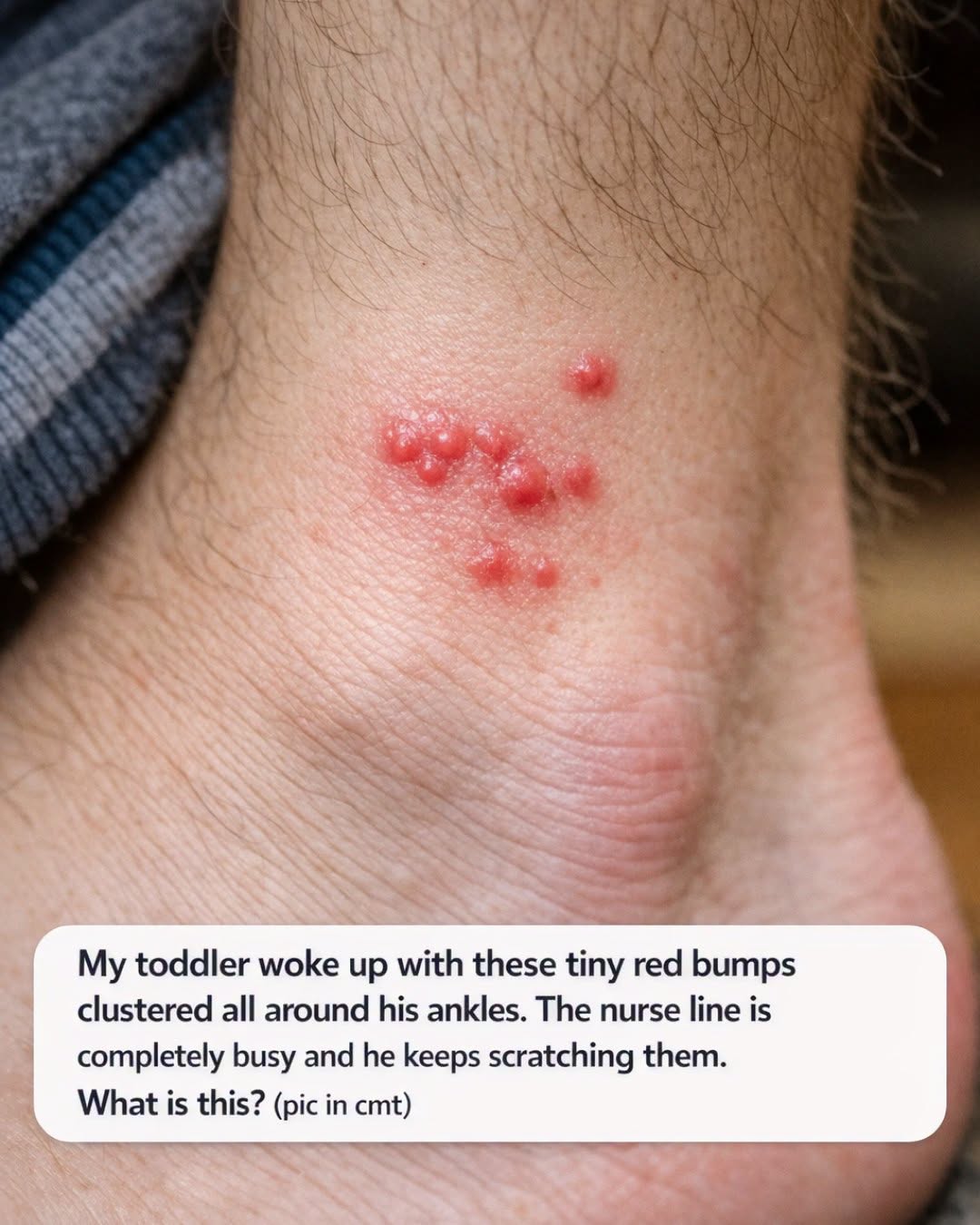 My toddler woke up with these tiny red bumps clustered all around his ankles. The nurse line is completely busy and he keeps scratching them. What is this?