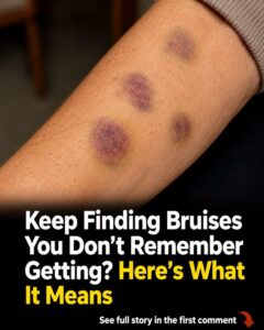 Unexplained Bruising on Your Body: Causes and Treatments