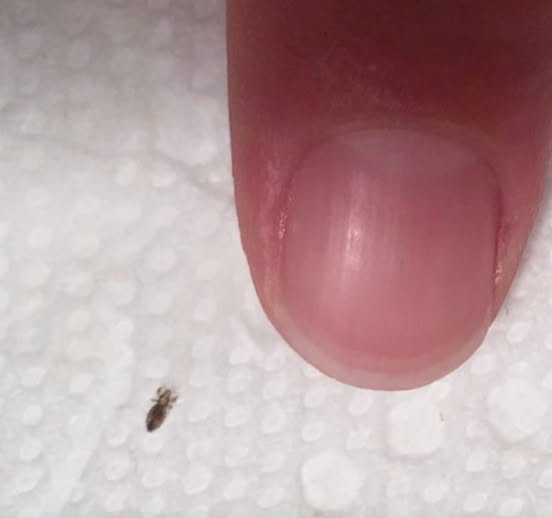 Head lice: How to get rid of them and stop them coming back
