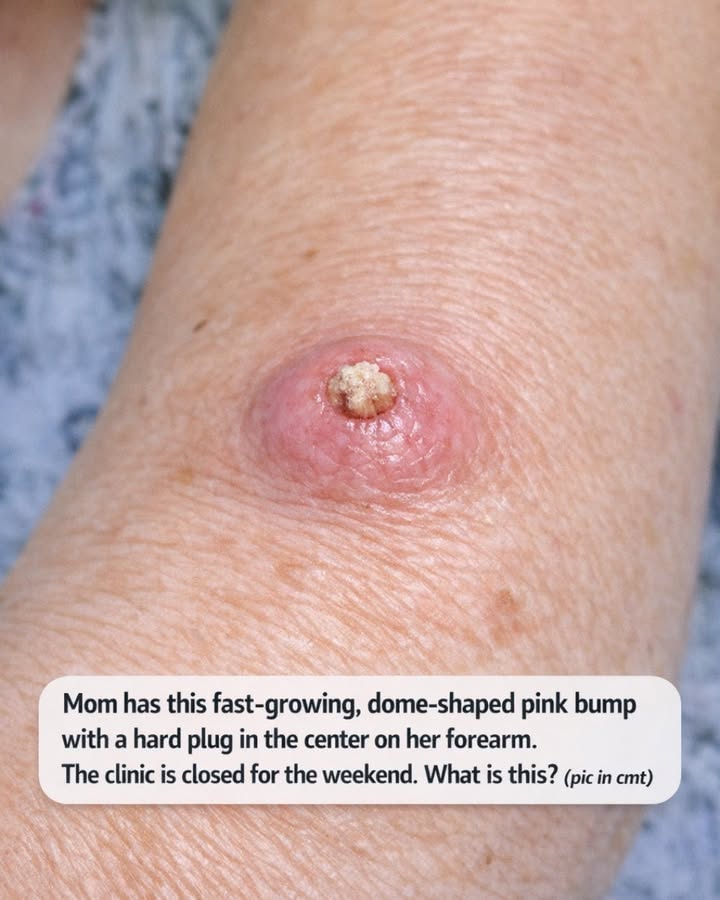 Mom has this fast-growing, dome-shaped pink bump with a hard plug in the center on her forearm. The clinic is closed for the weekend. What is this?