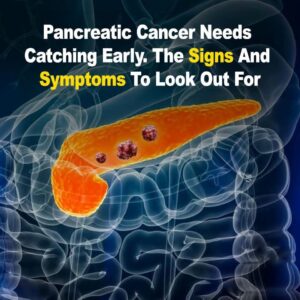 10 Signs of Pancreatic Cancer You Should Never Ignore