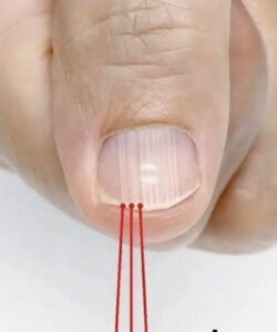 If you have these lines on your nails after the age of 40, it is a clear sign that…