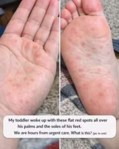 My toddler woke up with these flat red spots all over his palms and the soles of his feet. We are hours from urgent care. What is this?