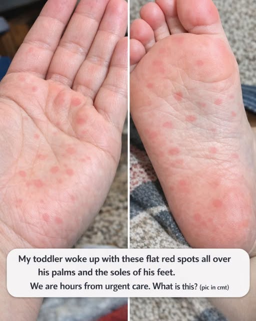 My toddler woke up with these flat red spots all over his palms and the soles of his feet. We are hours from urgent care. What is this?