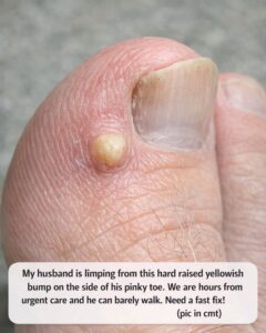 My husband is limping from this hard raised yellowish bump on the side of his pinky toe. We are hours from urgent care and he can barely walk. Need a fast fix!