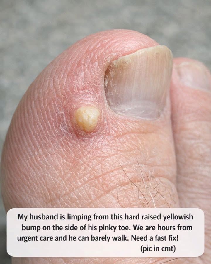 My husband is limping from this hard raised yellowish bump on the side of his pinky toe. We are hours from urgent care and he can barely walk. Need a fast fix!