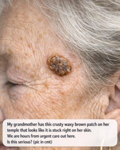 My grandmother has this crusty waxy brown patch on her temple that looks like it is stuck right on her skin. We are hours from urgent care out here. Is this serious?