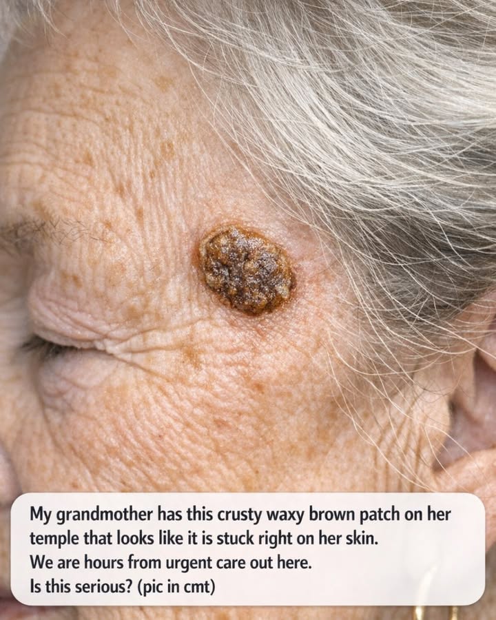 My grandmother has this crusty waxy brown patch on her temple that looks like it is stuck right on her skin. We are hours from urgent care out here. Is this serious?