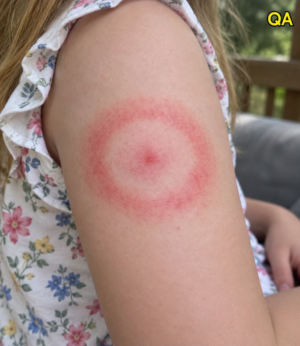 AN. The Red Ring of Terror: Is Your Child’s Mysterious Rash a Harmless Bug Bite or a Life-Changing Diagnosis?