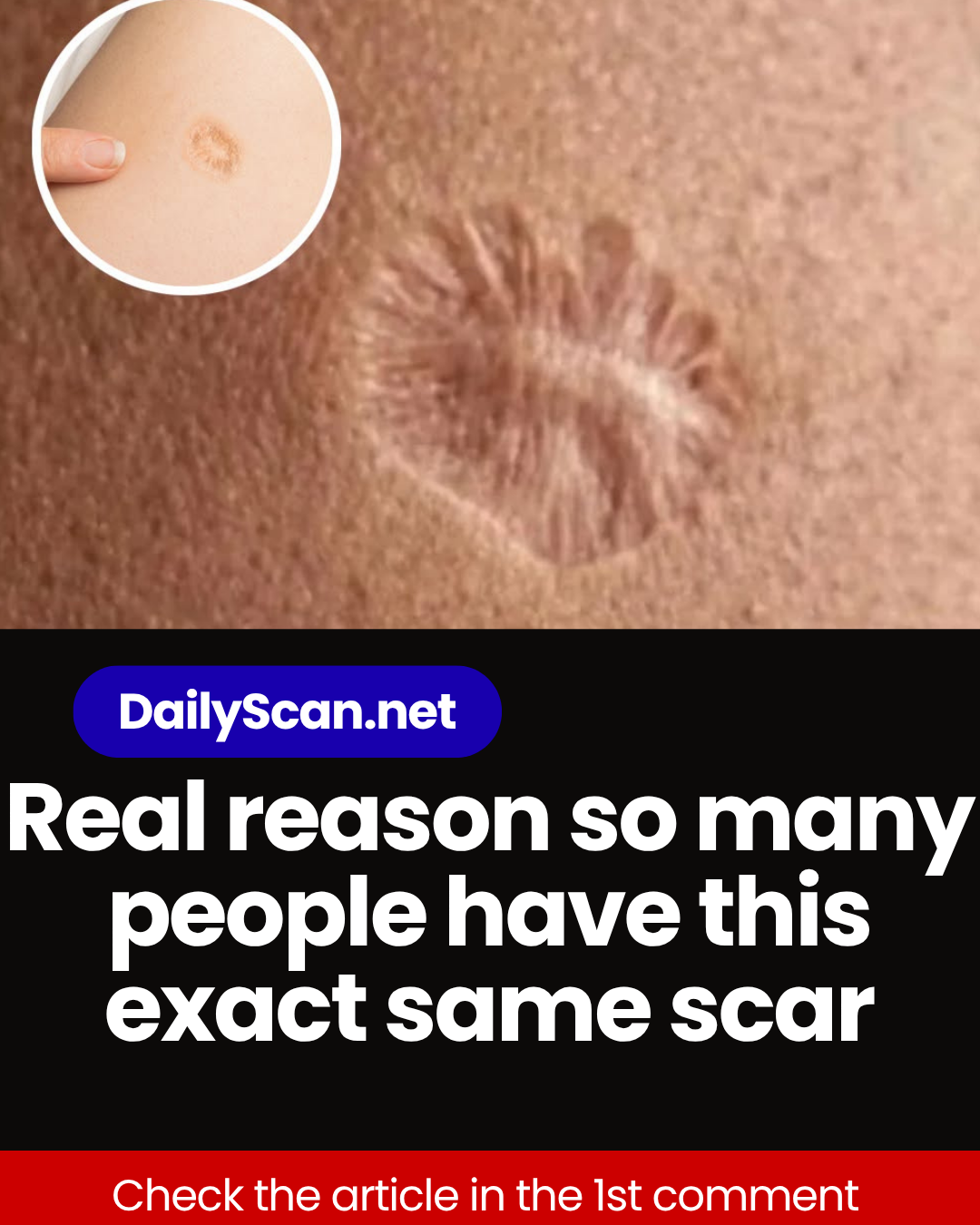 Real reason so many people have this exact same scar