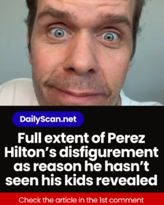 Full extent of Perez Hilton’s disfigurement as reason he hasn’t seen his kids revealed