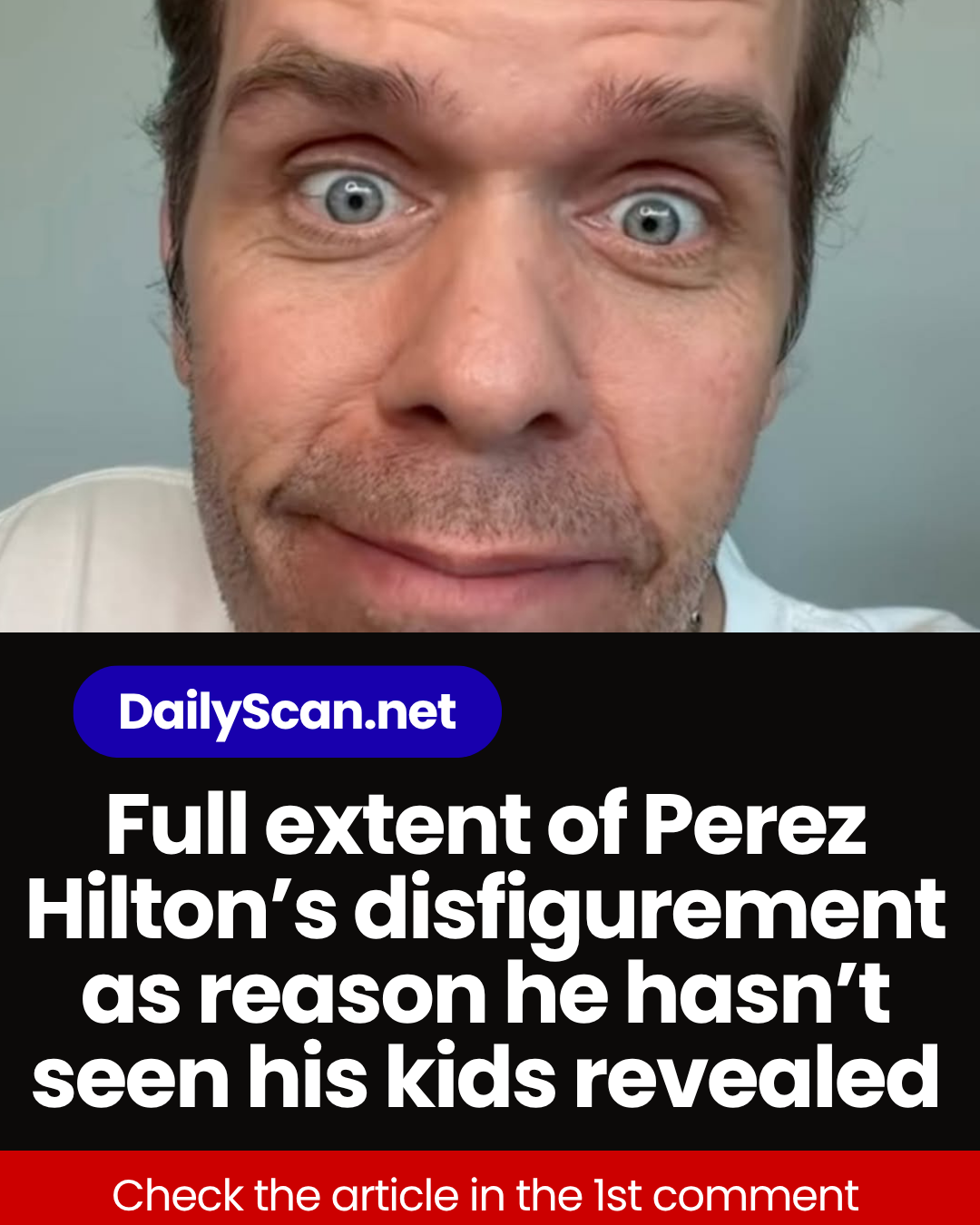 Full extent of Perez Hilton’s disfigurement as reason he hasn’t seen his kids revealed