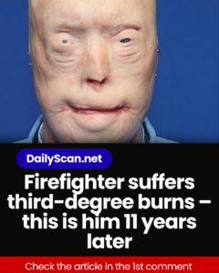 Firefighter suffers third-degree burns – this is him 11 years later