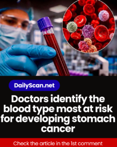 Doctors identify the blood type most at risk for developing stomach cancer
