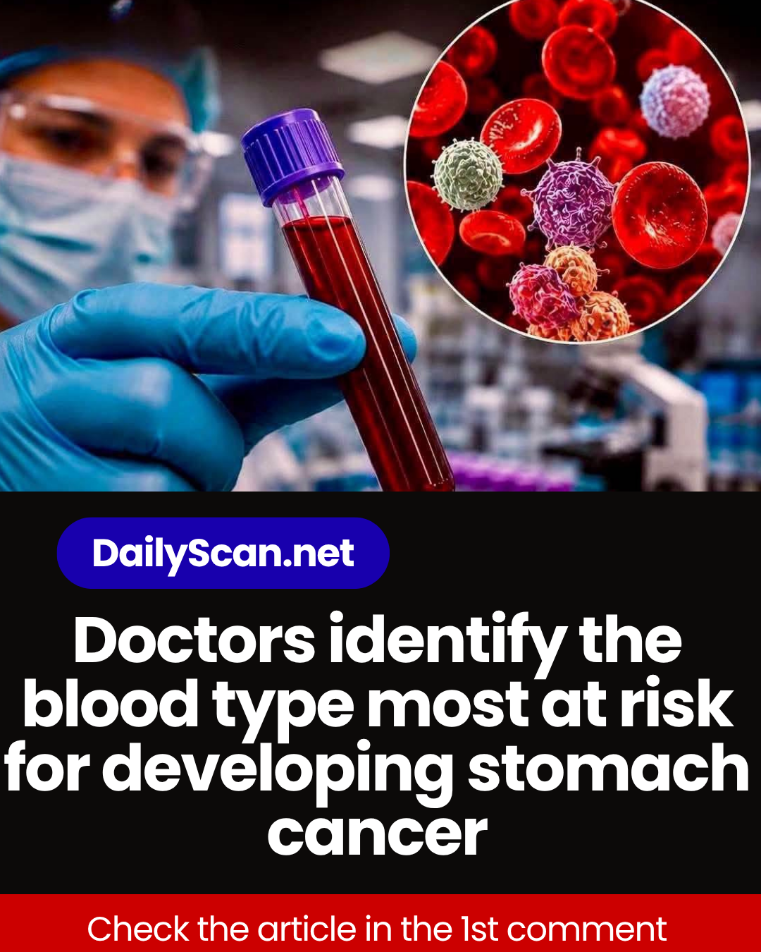 Doctors identify the blood type most at risk for developing stomach cancer