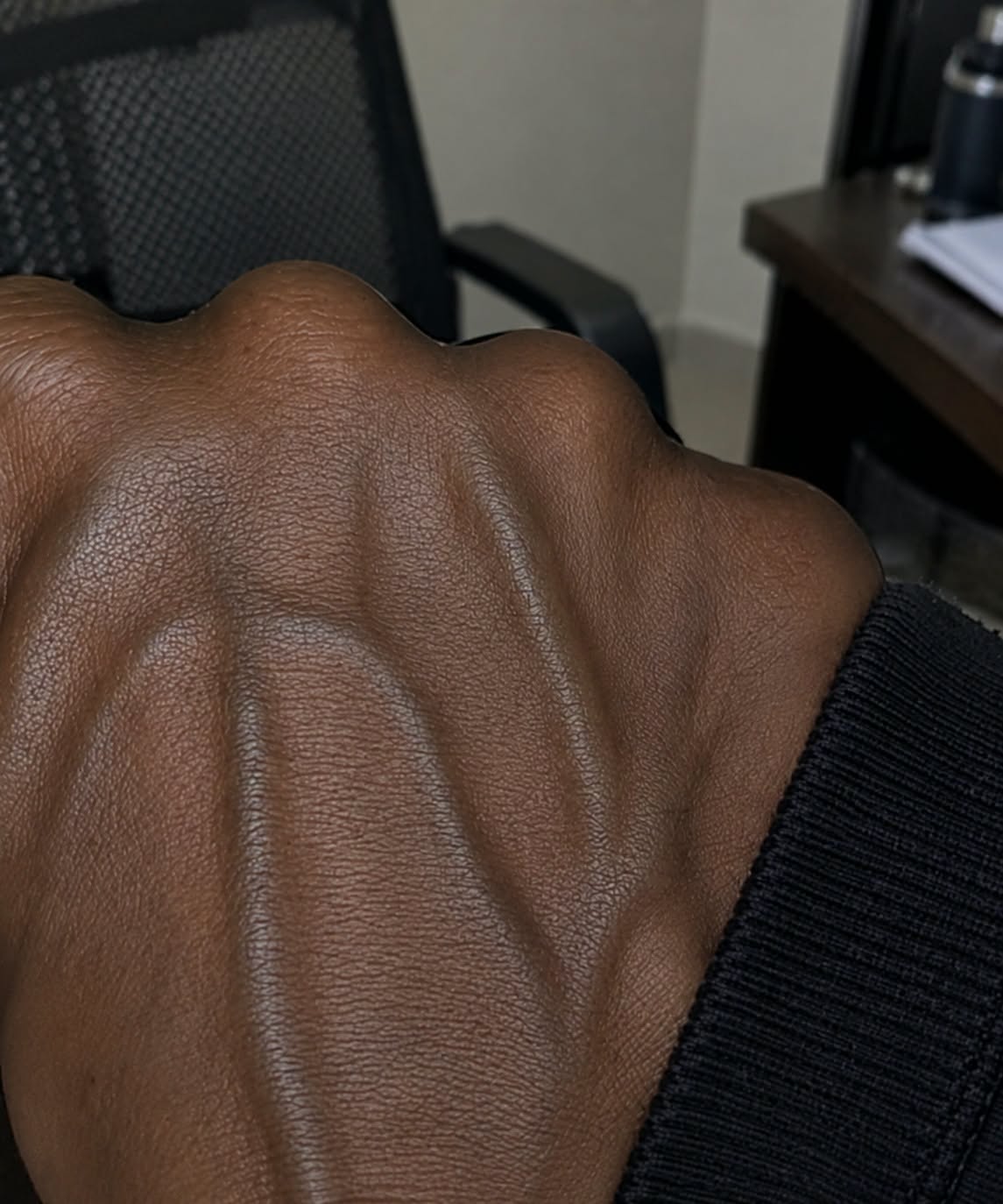 Why Are the Veins on Your Hands Suddenly More Visible? Common Reasons Explained