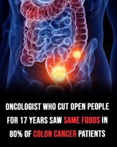 Oncologist who cut open people for 17 years saw the same foods in 80% of colon cancer patients