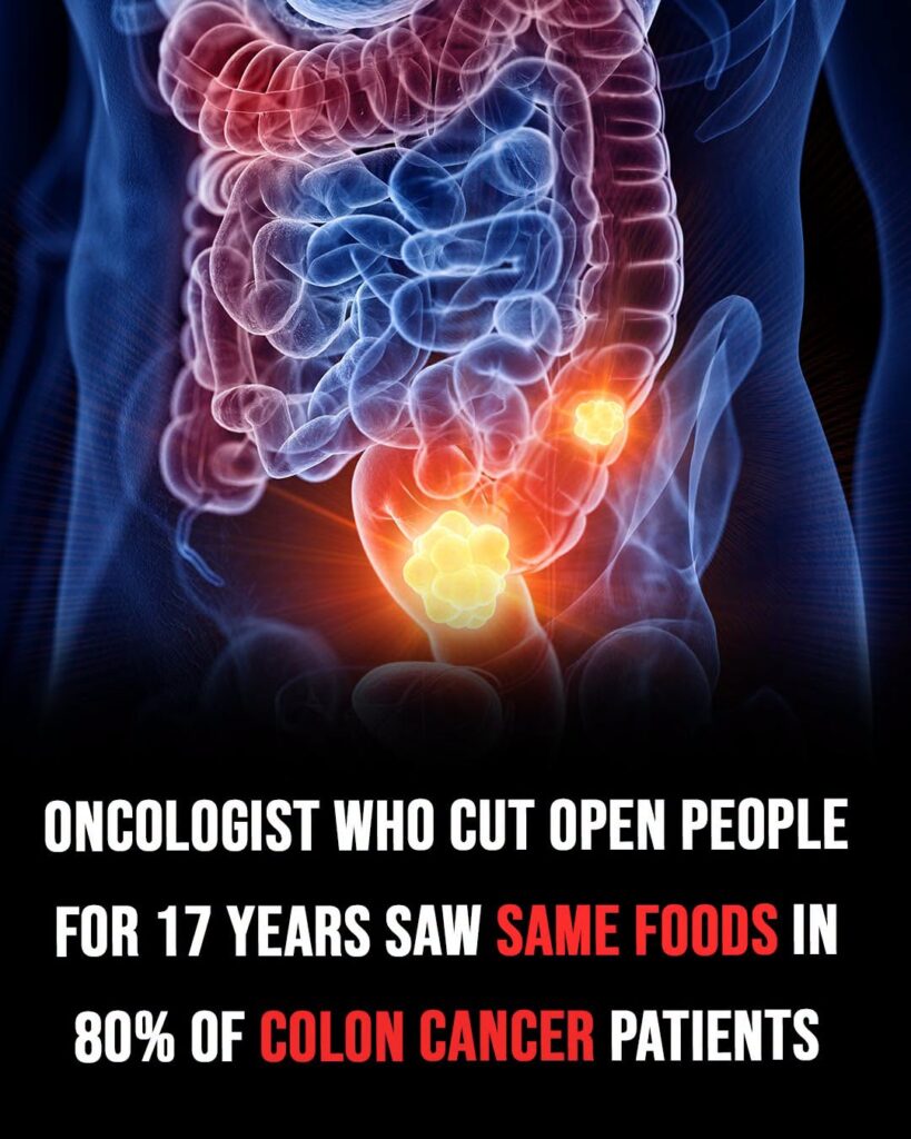 Oncologist who cut open people for 17 years saw the same foods in 80% of colon cancer patients
