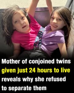 Mother of conjoined twins given just 24 hours to live reveals why she refused to separate them