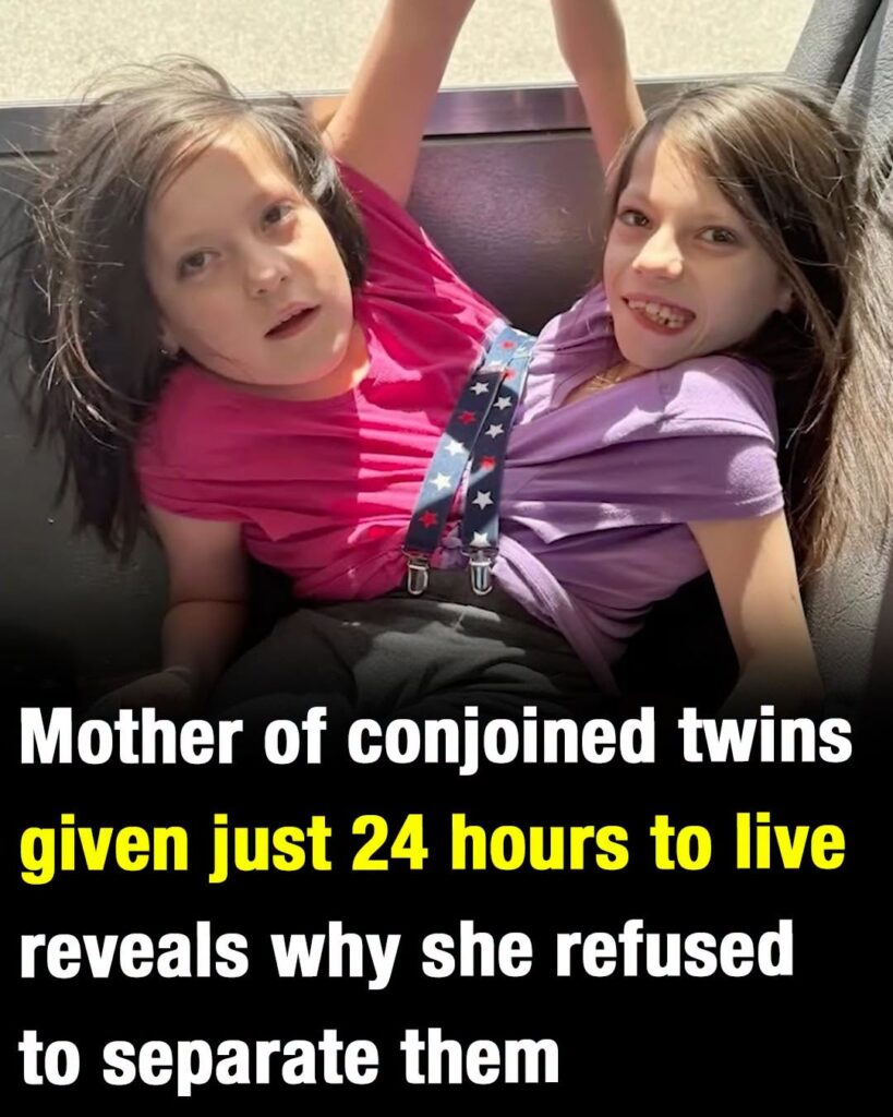 Mother of conjoined twins given just 24 hours to live reveals why she refused to separate them