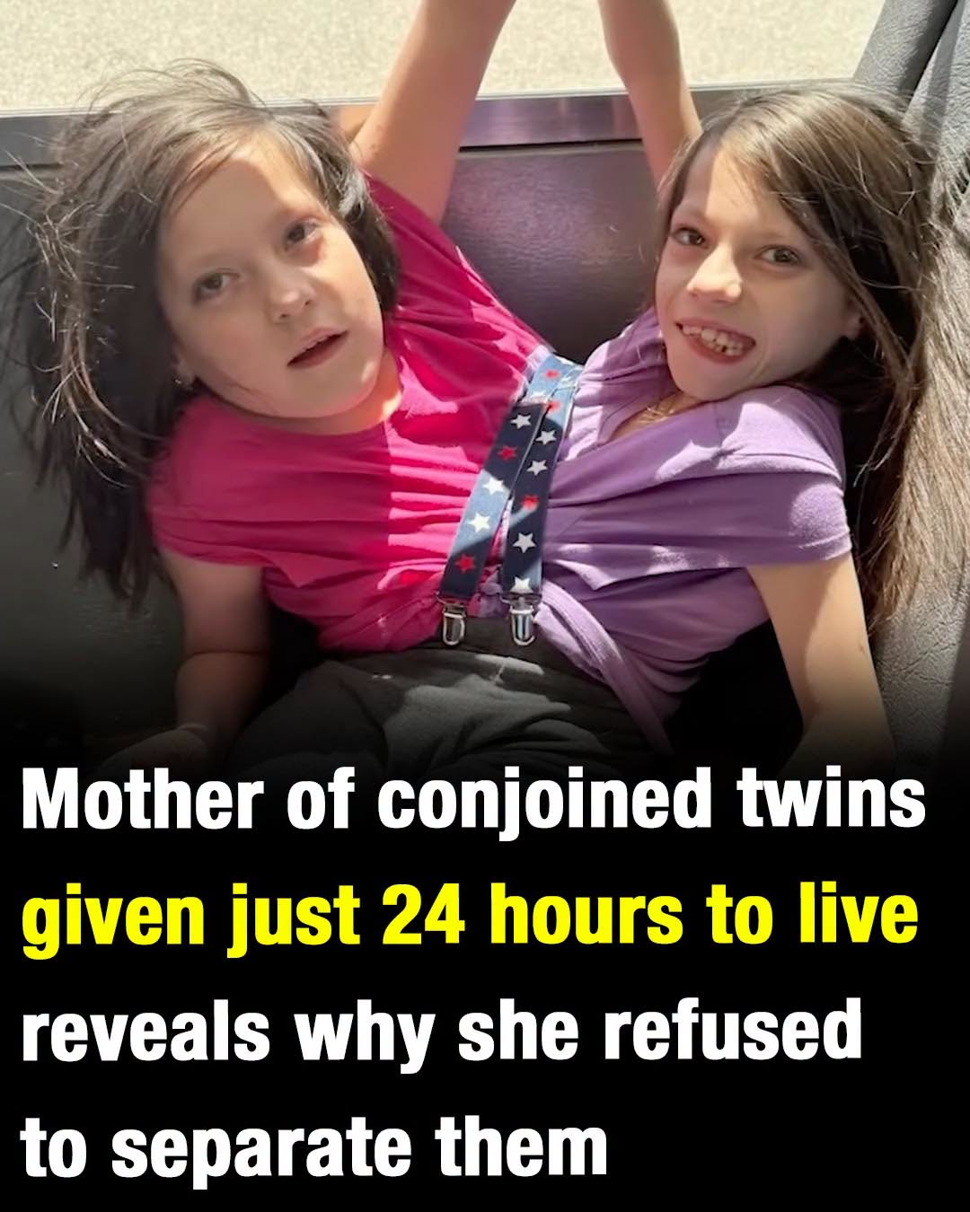 Mother of conjoined twins given just 24 hours to live reveals why she refused to separate them