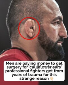 Men are reportedly paying to get ‘cauliflower ears’ to look like ‘fighters’