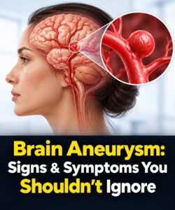 12 signs that may signal a brain aneurysm — Don’t ignore them
