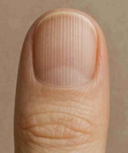 What Do Vertical Lines on Your Nails Really Mean?