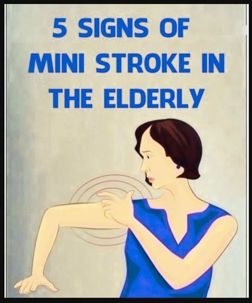 Mini Str0ke in the Elderly: Common and Unusual Symptoms