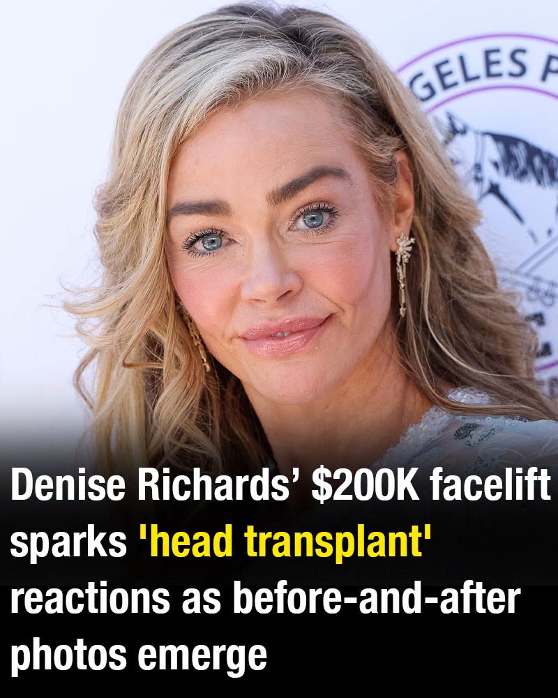Denise Richards’ $200K facelift sparks ‘head transplant’ reactions as before-and-after photos emerge
