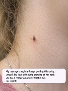 My teenage daughter keeps getting this spiky, thread-like little skin bump growing on her neck. She has a recital tomorrow. What is this?.