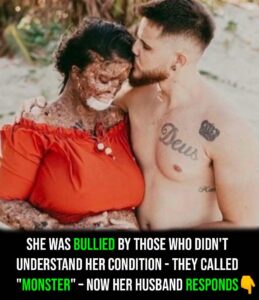 Woman with rare skin condition overcomes negativity and finds true love