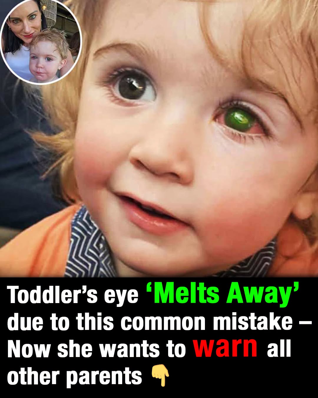 Toddler’s eye ”melts away” after wrong person kissed him