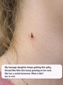 What Is This Tiny Spiky Bump on My Daughter’s Neck?