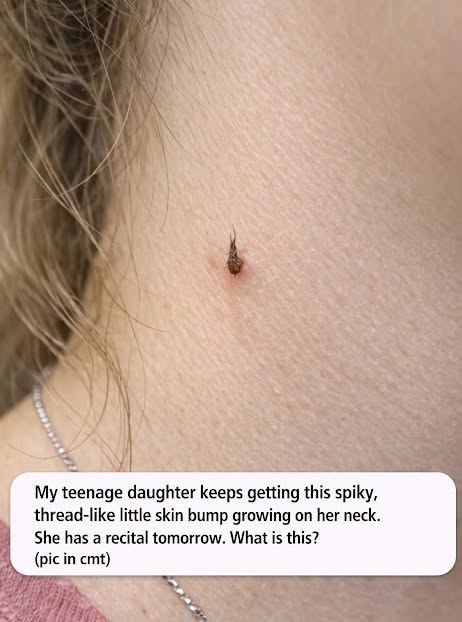 What Is This Tiny Spiky Bump on My Daughter’s Neck?